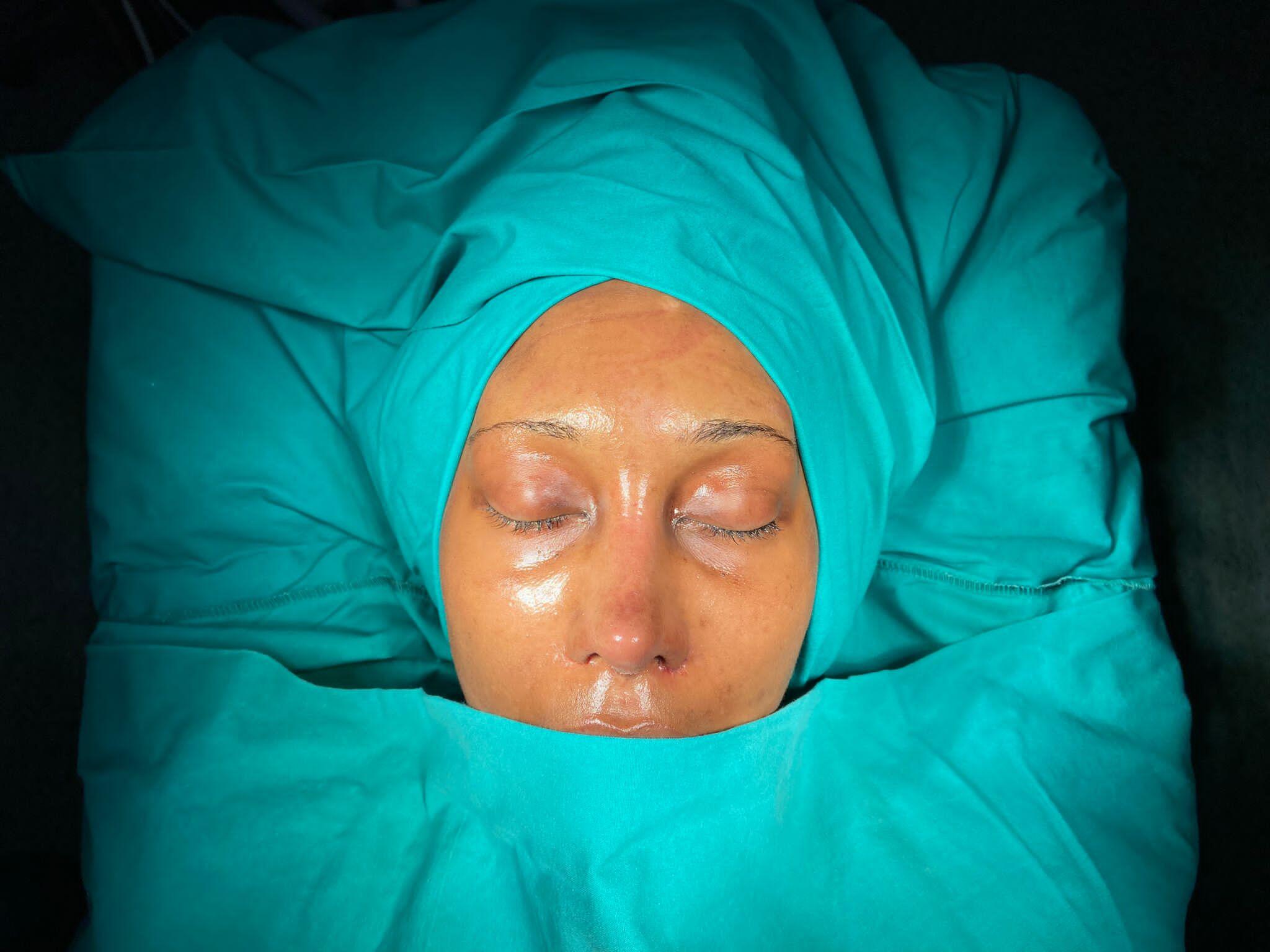Revision Rhinoplasty 1-3