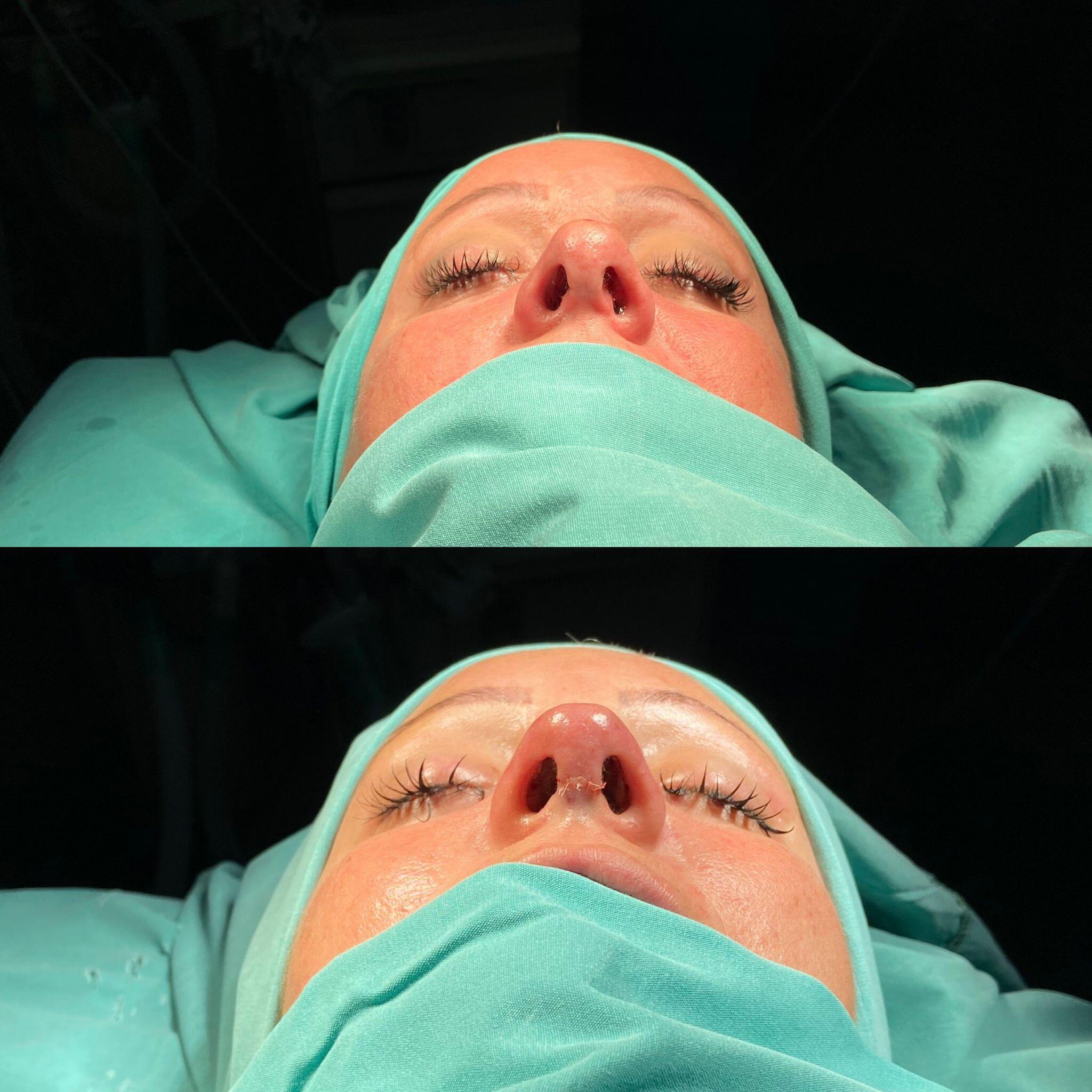 Revision Rhinoplasty 2-1