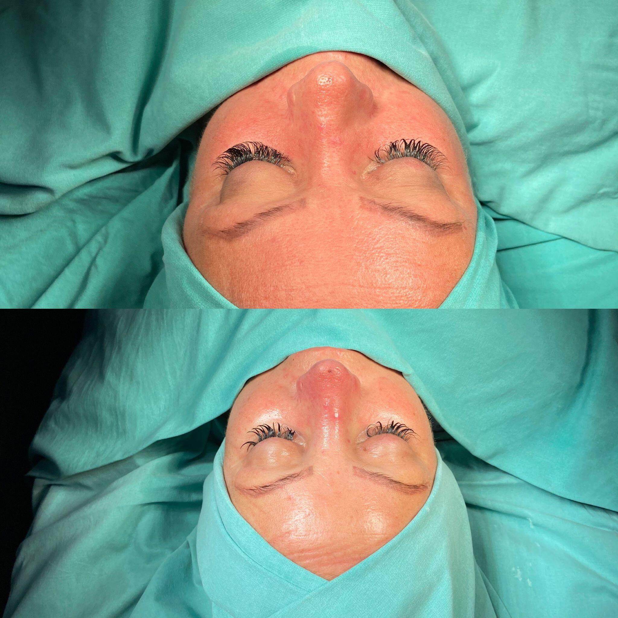 Revision Rhinoplasty 2-2