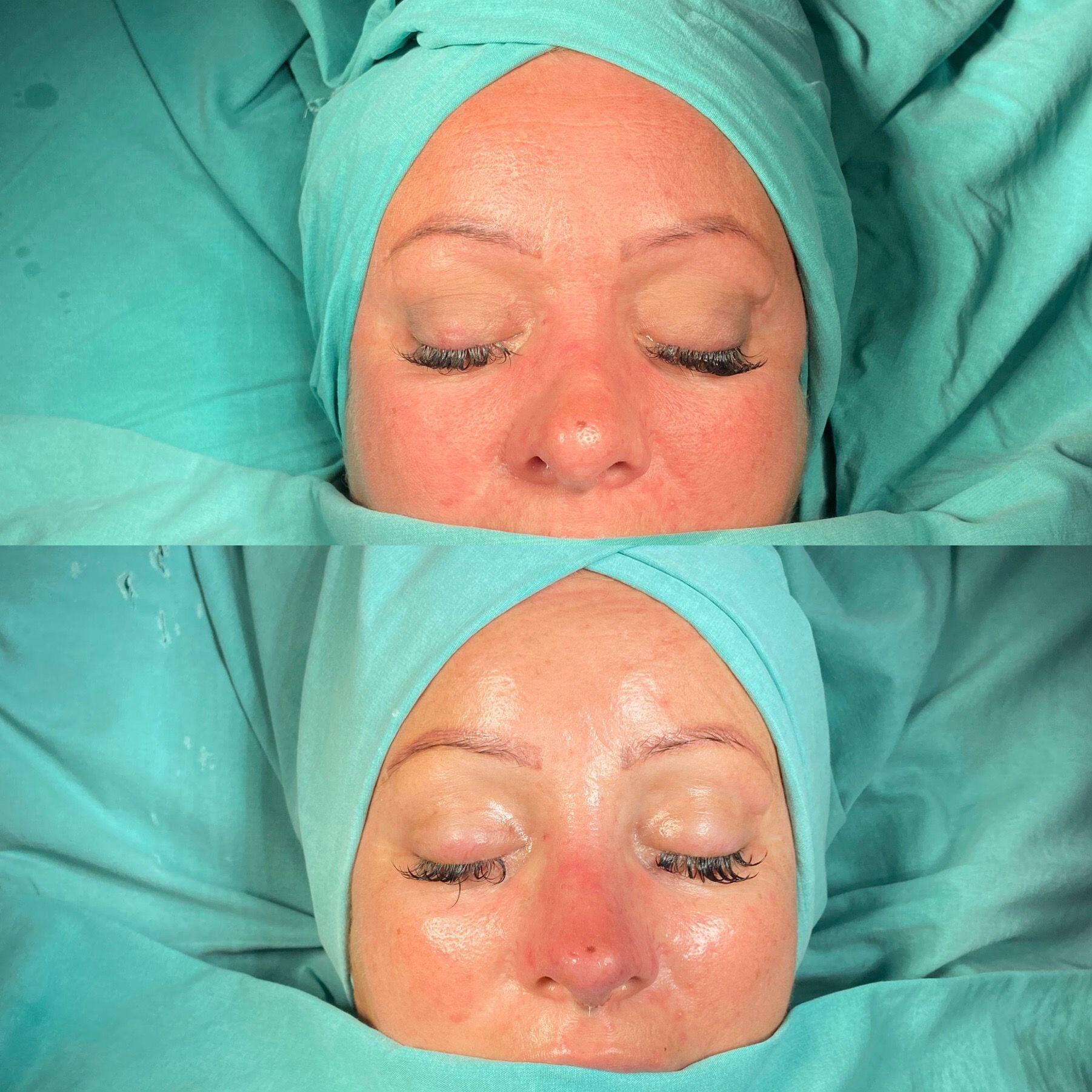 Revision Rhinoplasty 2-3