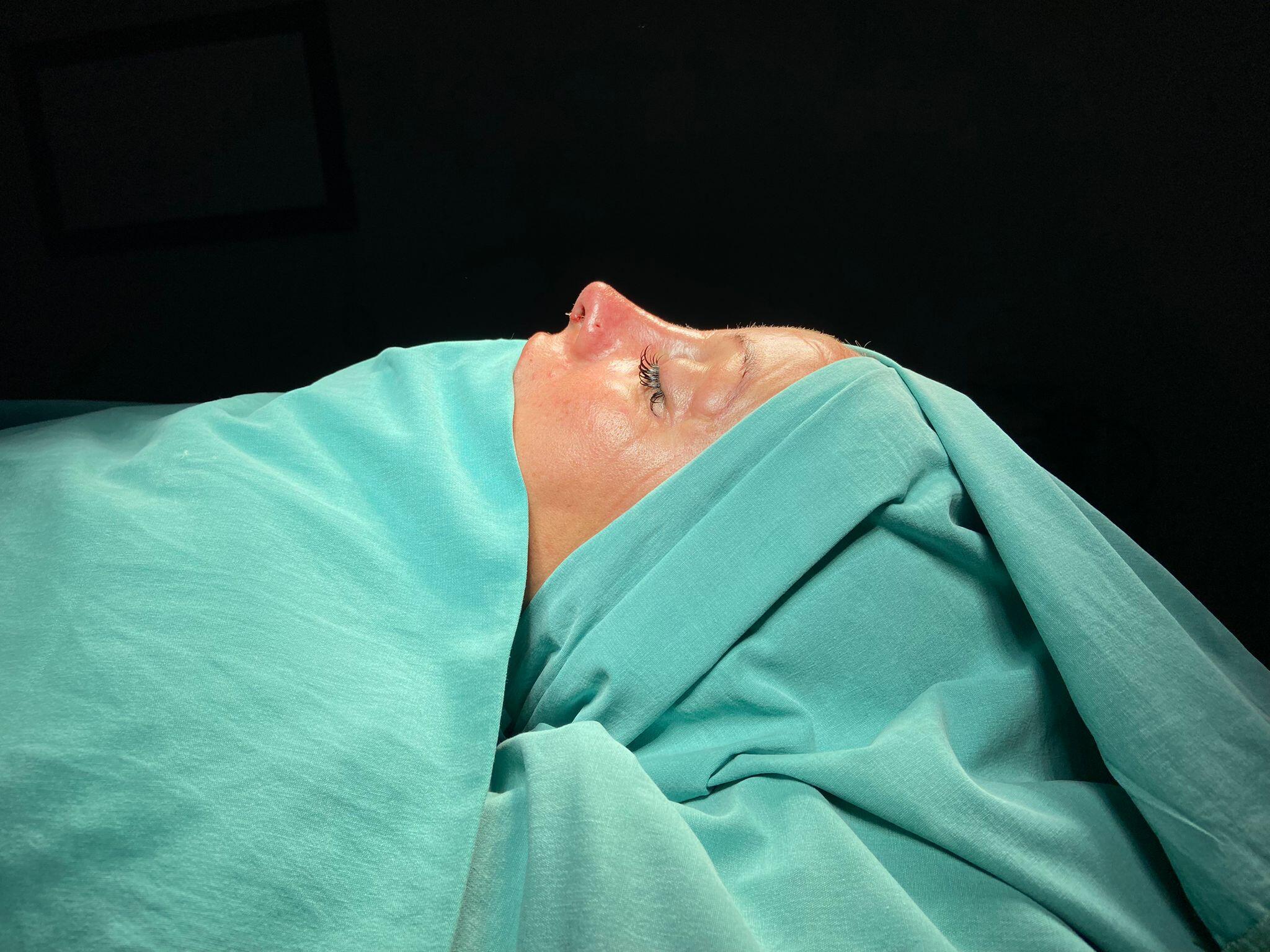 Revision Rhinoplasty 2-4