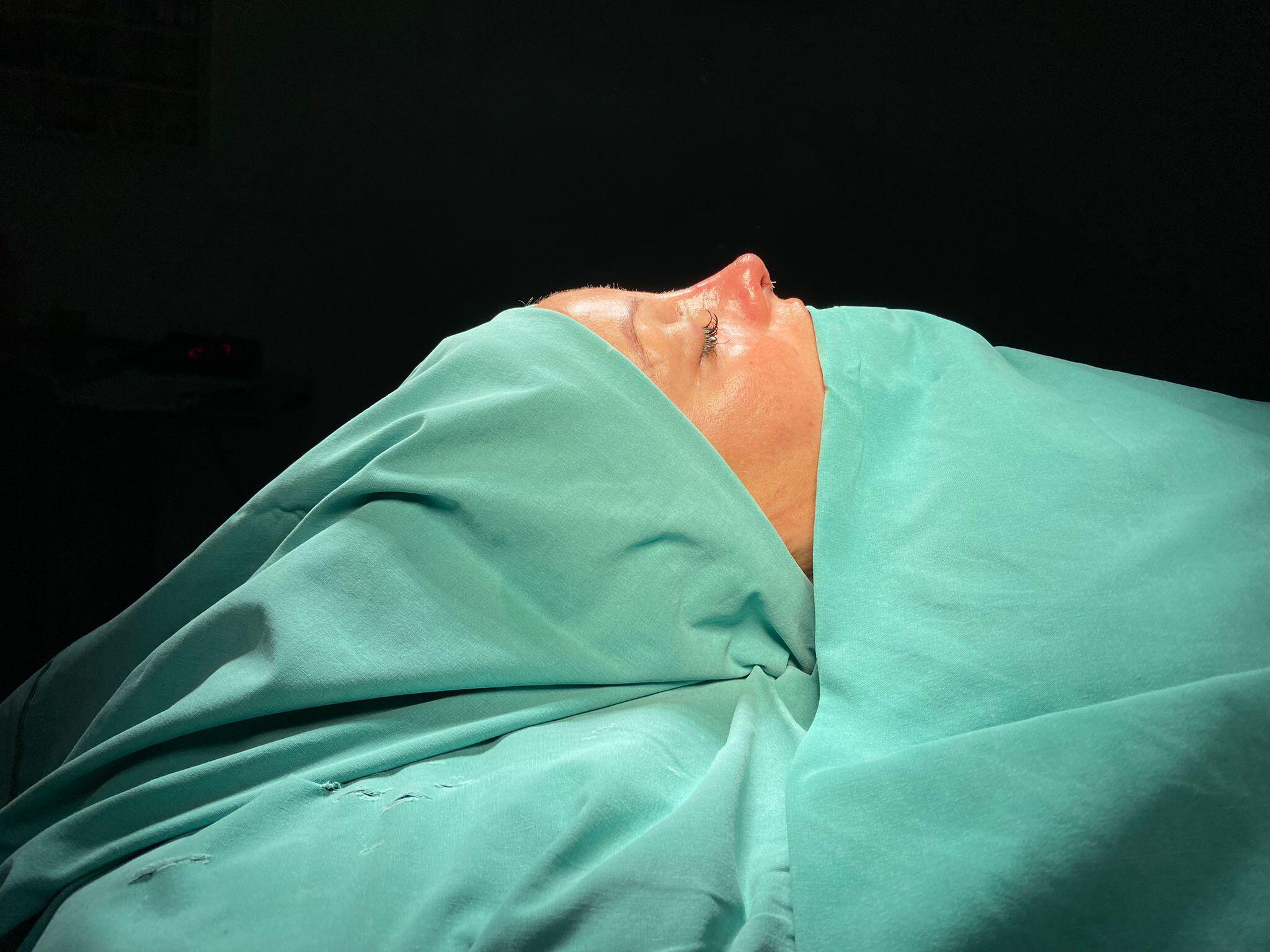 Revision Rhinoplasty 2-5