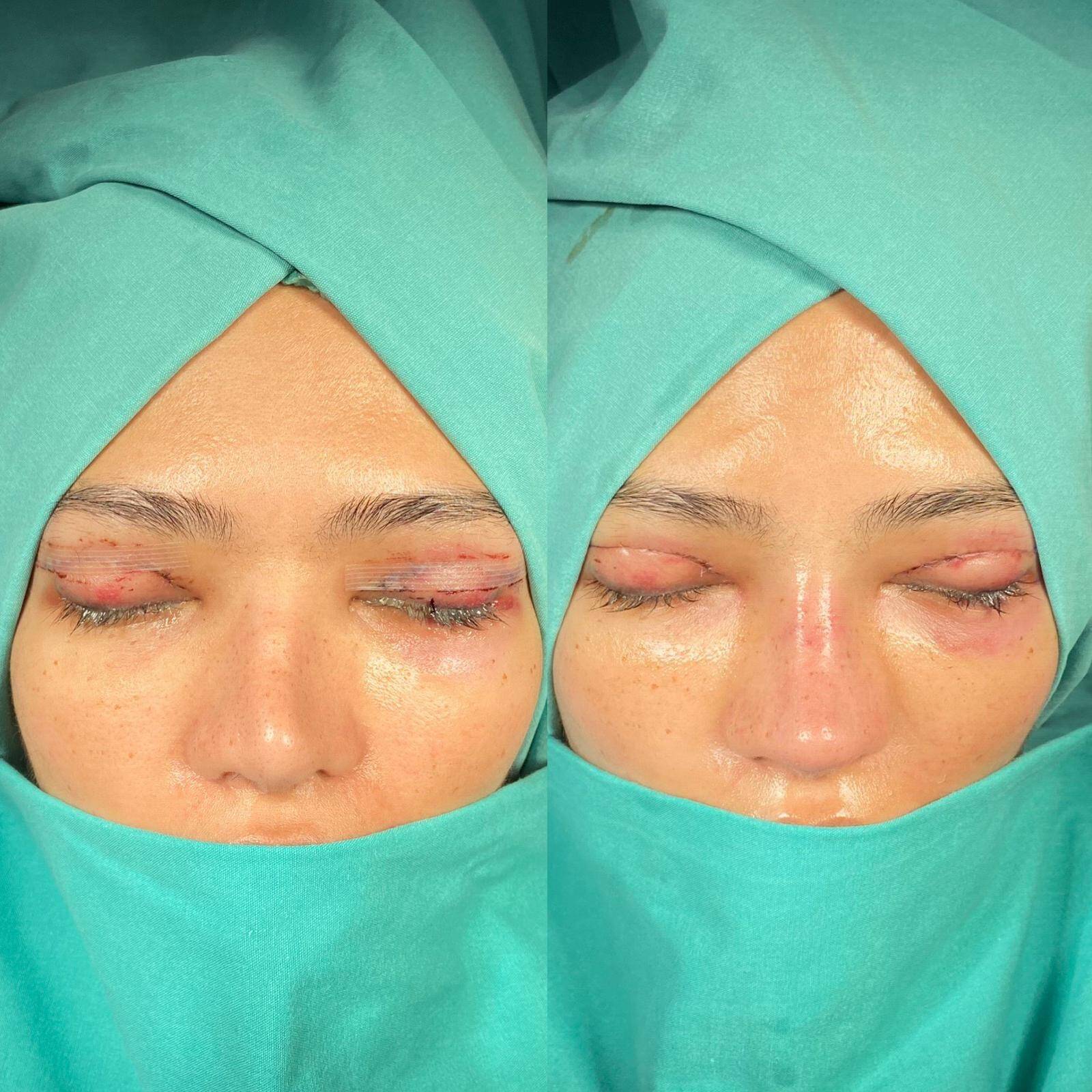 Revision Rhinoplasty 3-1