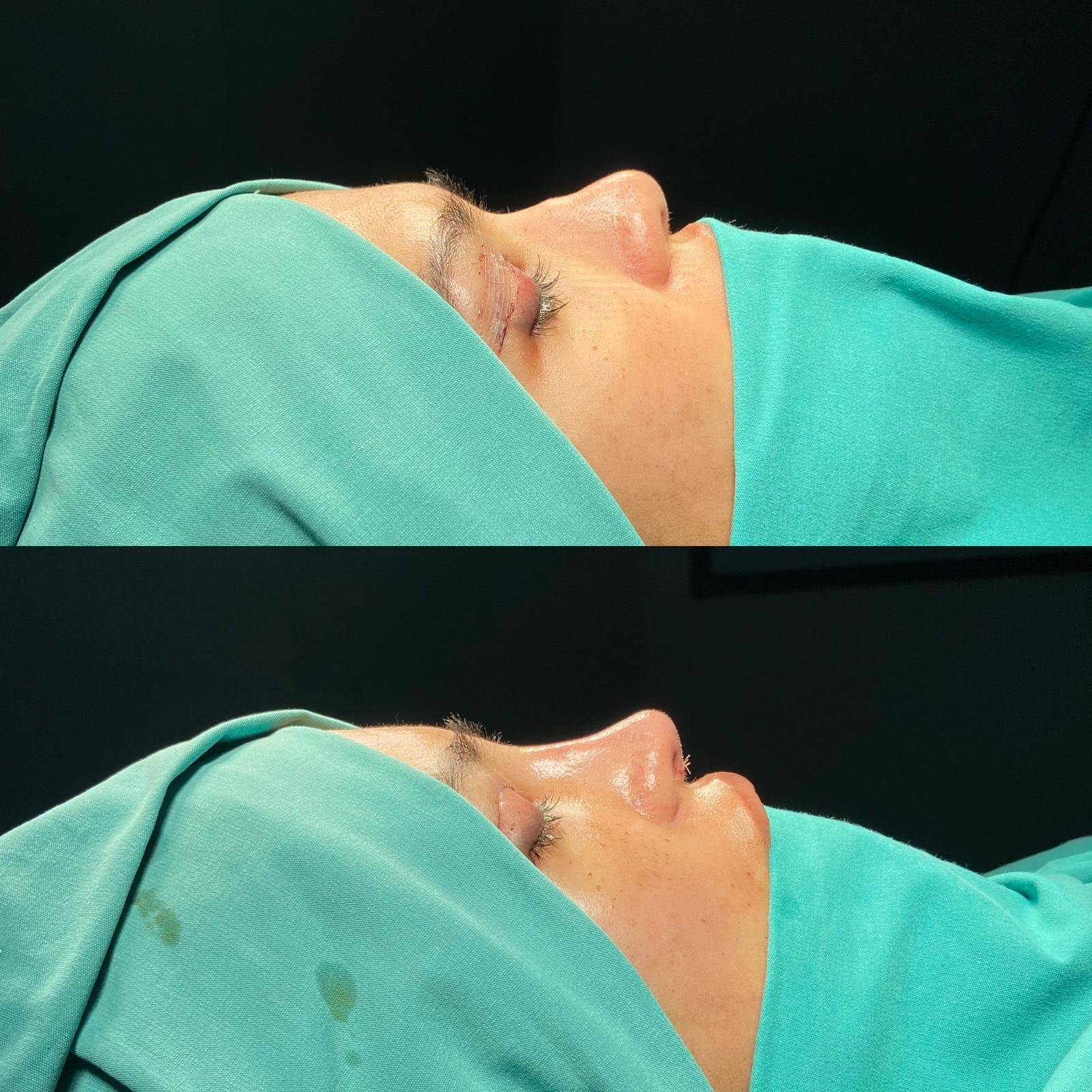 Revision Rhinoplasty 3-2