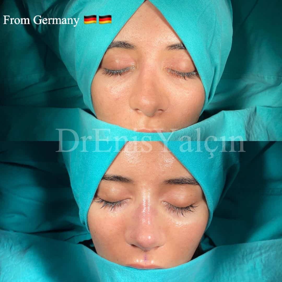 Revision Rhinoplasty 4-1