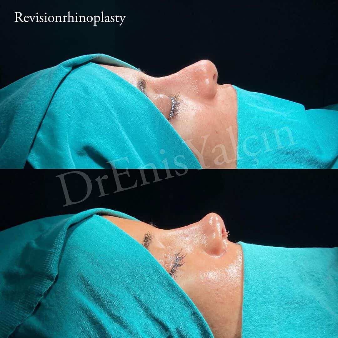 Revision Rhinoplasty 4-2