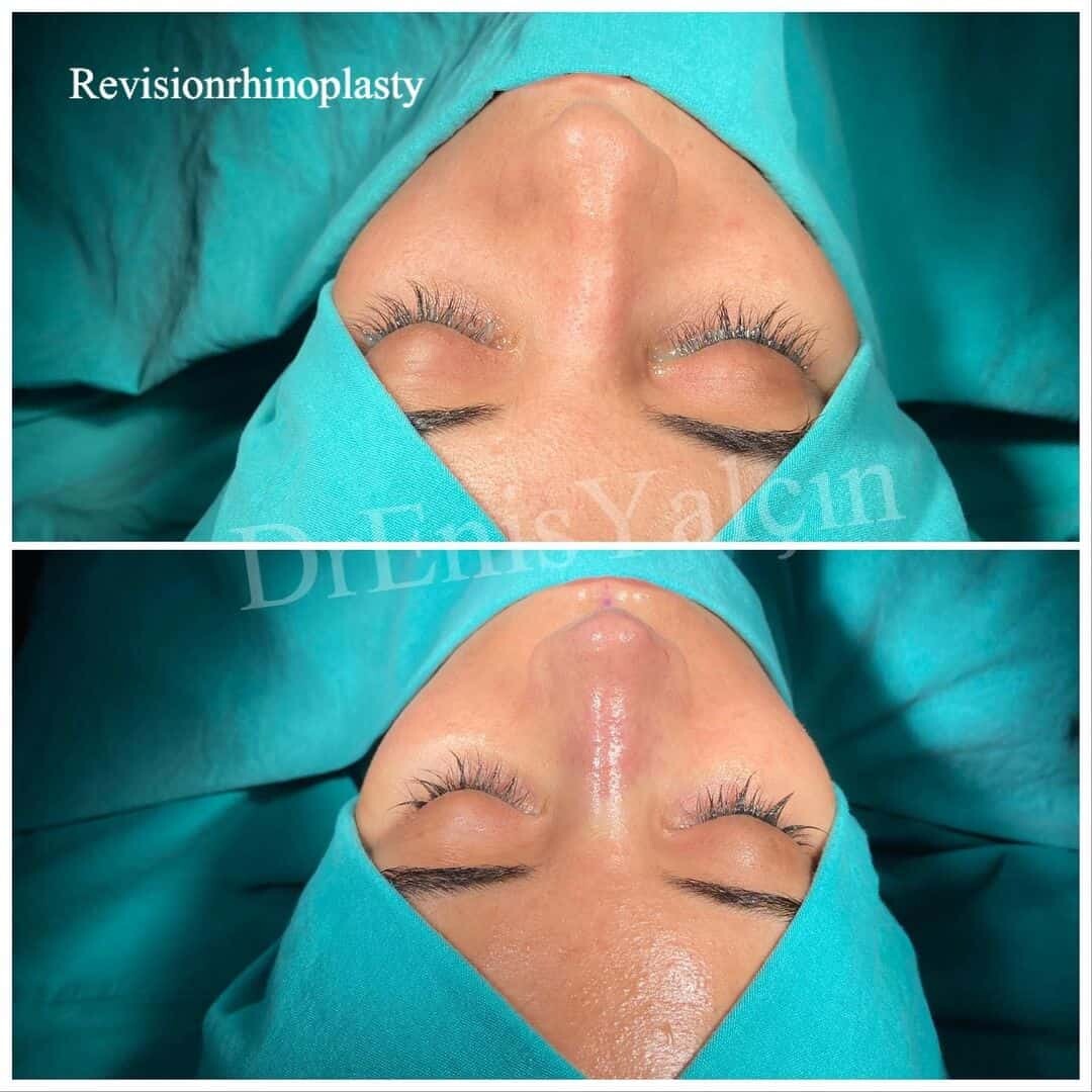 Revision Rhinoplasty 4-3