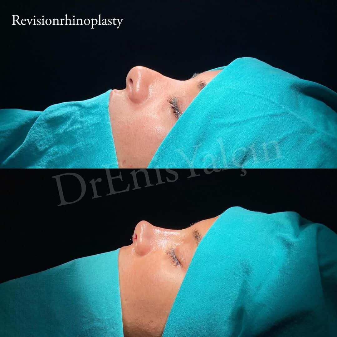 Revision Rhinoplasty 4-4