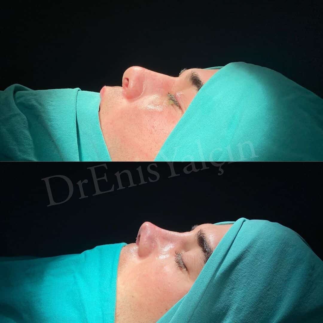 Revision Rhinoplasty 5-1