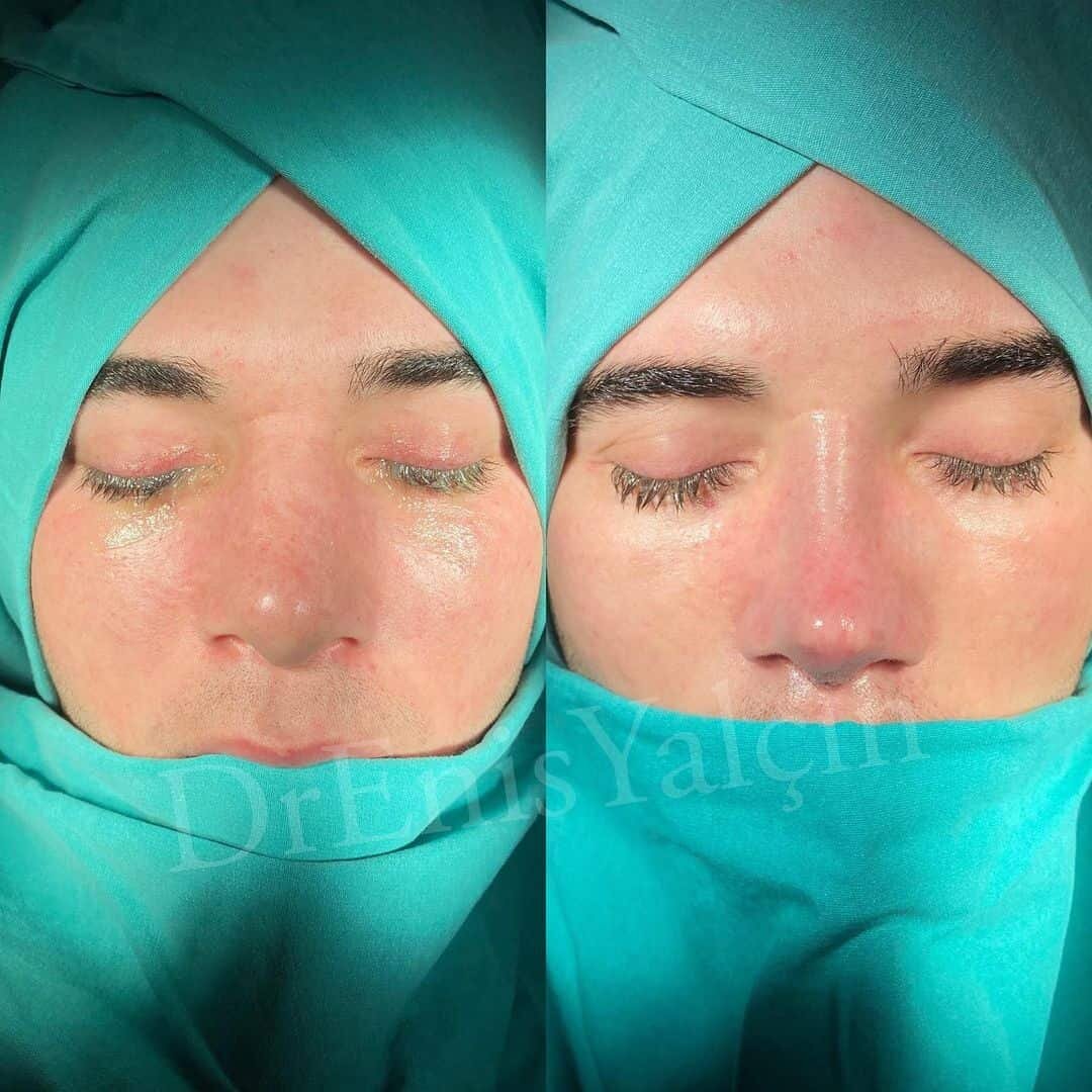 Revision Rhinoplasty 5-2