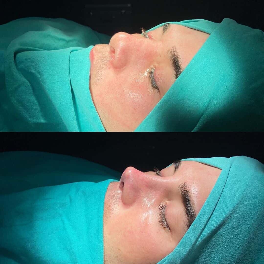 Revision Rhinoplasty 5-4