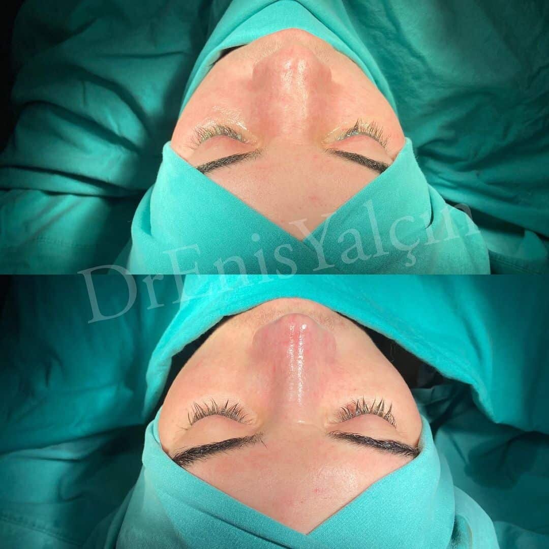 Revision Rhinoplasty 5-5