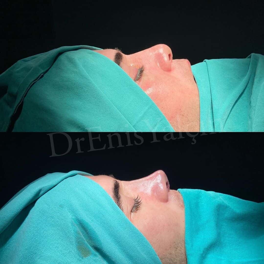 Revision Rhinoplasty 5-6