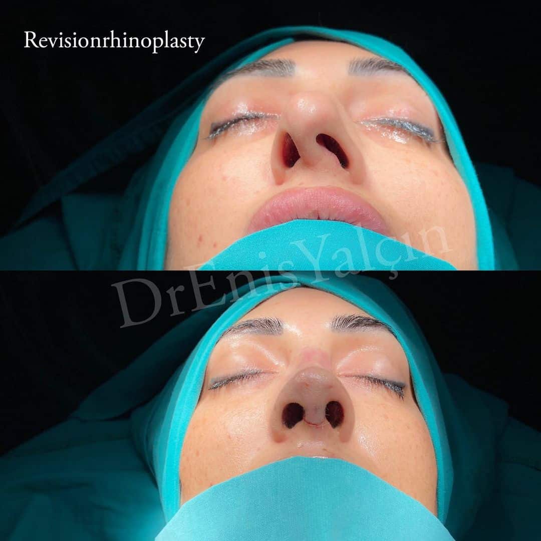 Revision Rhinoplasty 6-1