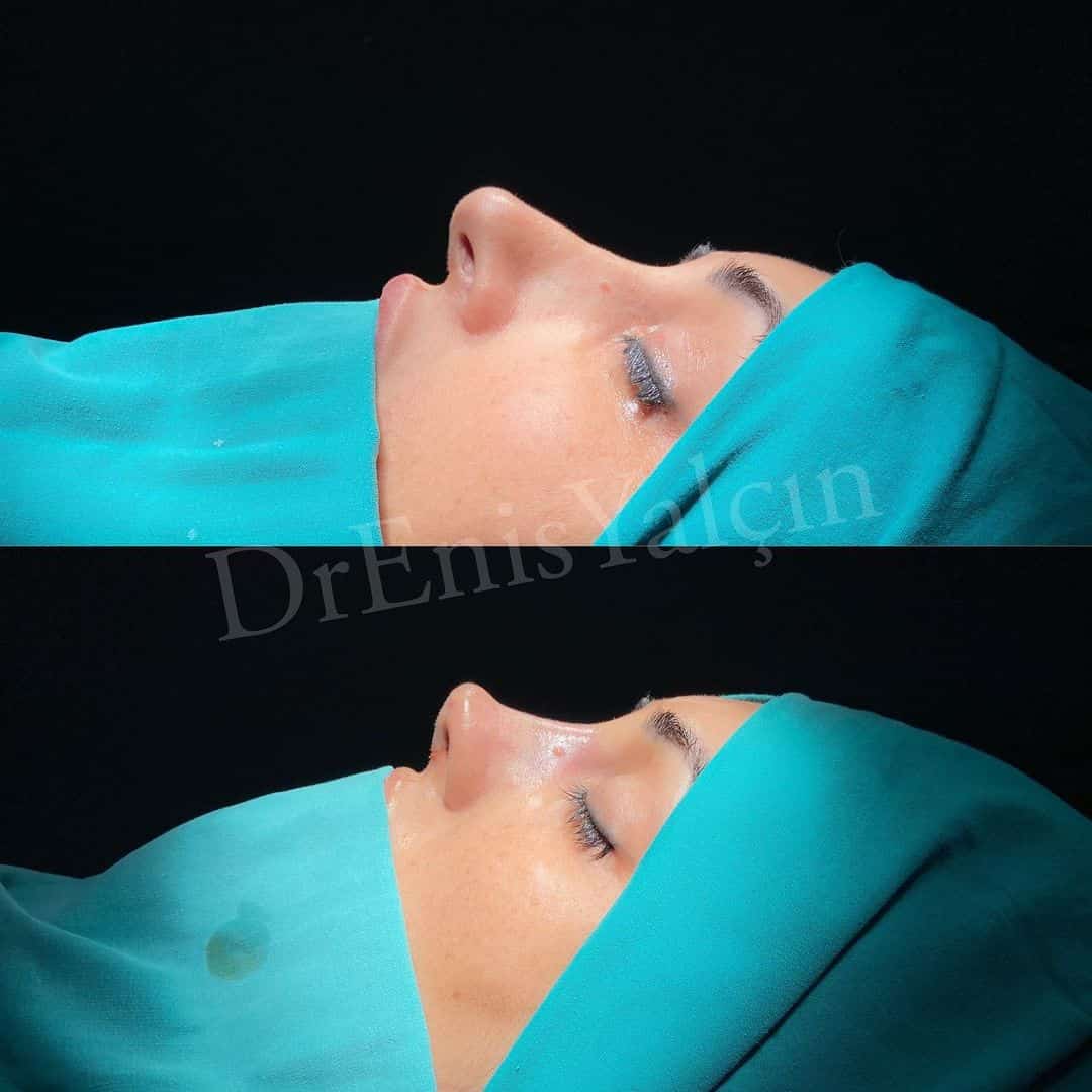 Revision Rhinoplasty 6-2