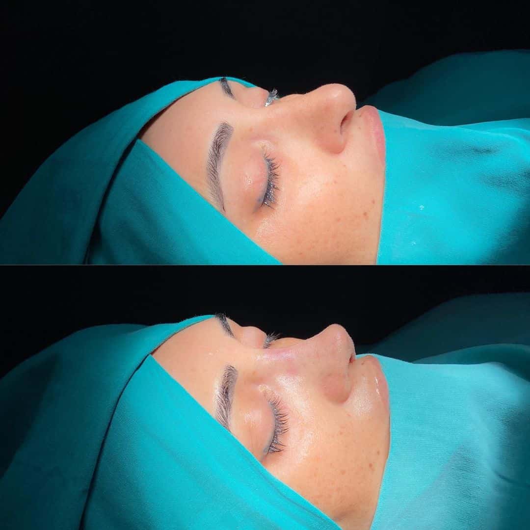 Revision Rhinoplasty 6-4
