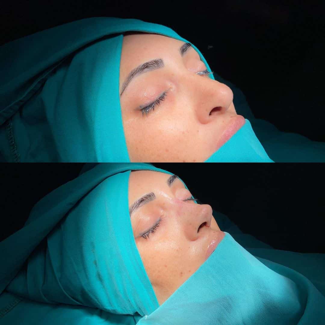 Revision Rhinoplasty 6-5