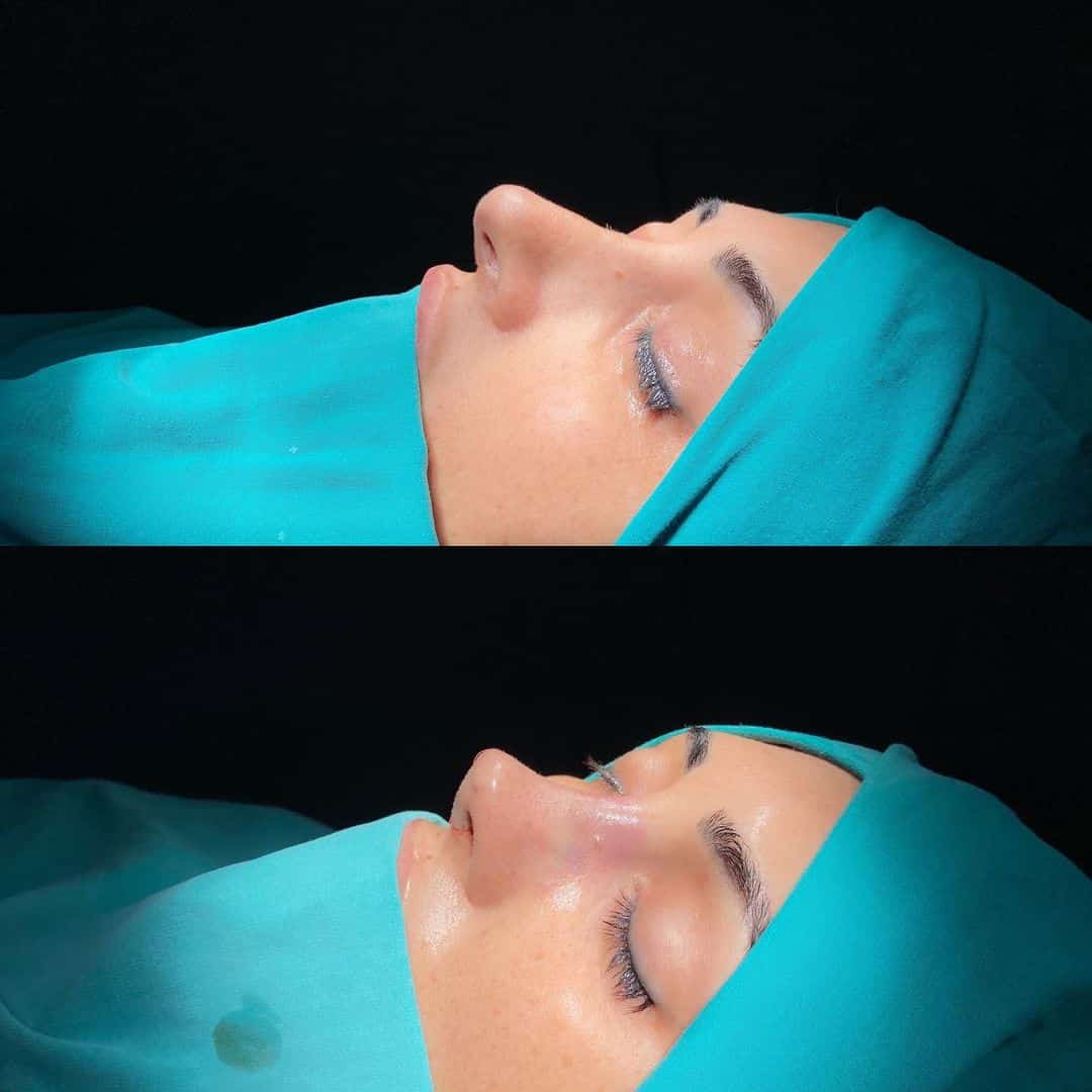 Revision Rhinoplasty 6-6