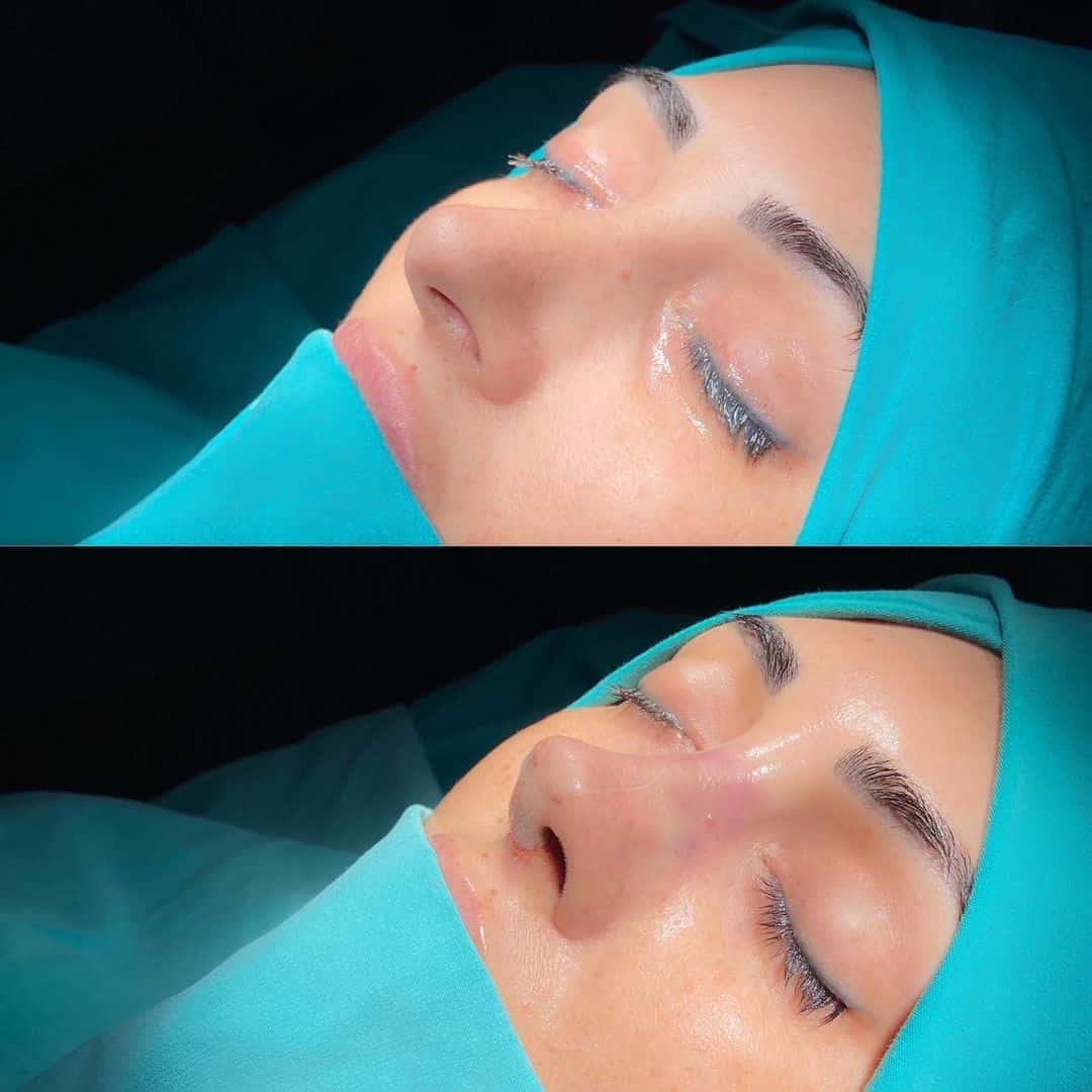 Revision Rhinoplasty 6-7