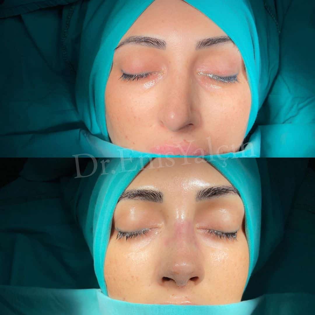 Revision Rhinoplasty 6-8