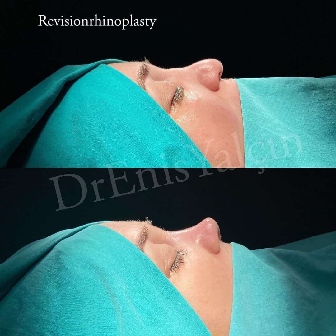 Revision Rhinoplasty 7-1