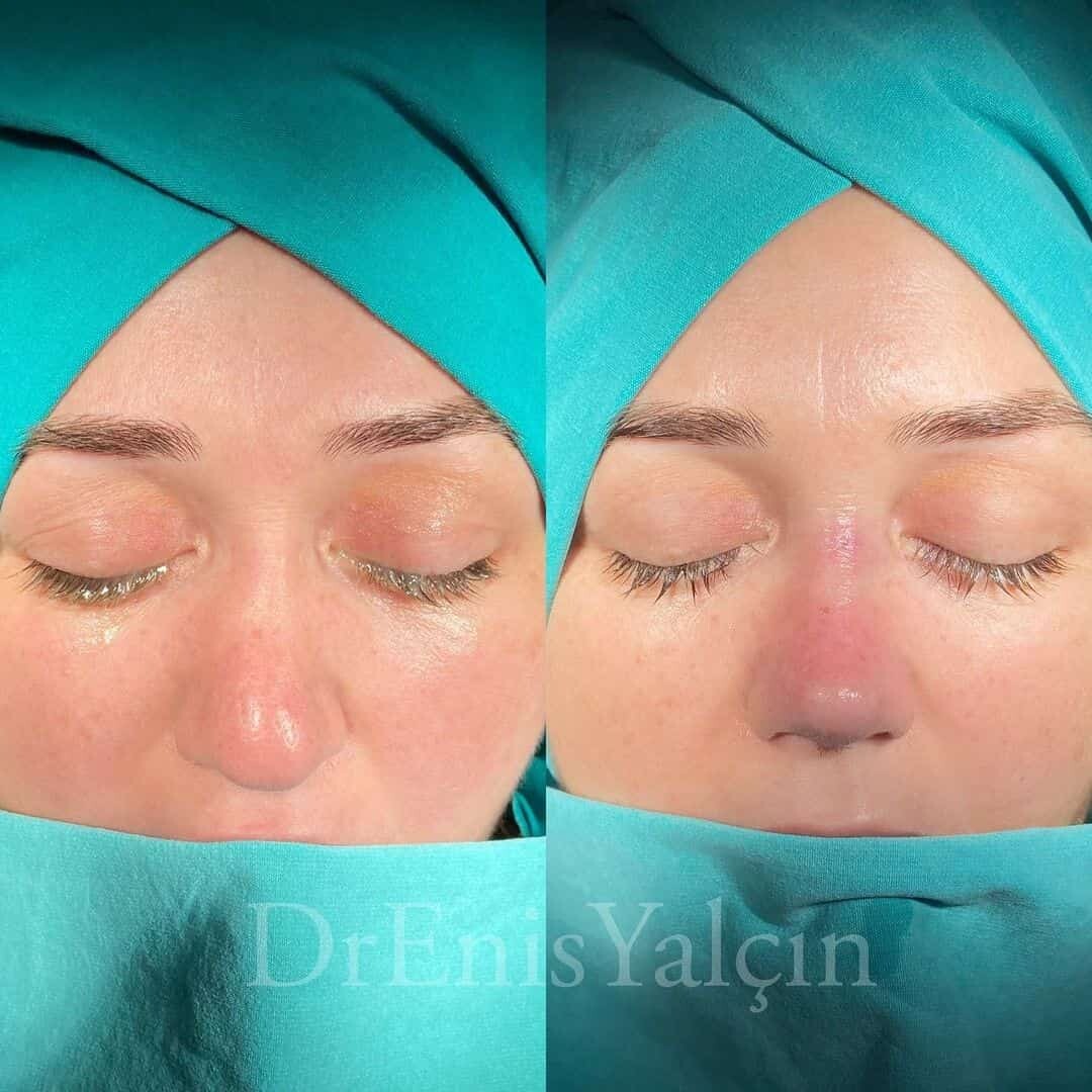 Revision Rhinoplasty 7-2