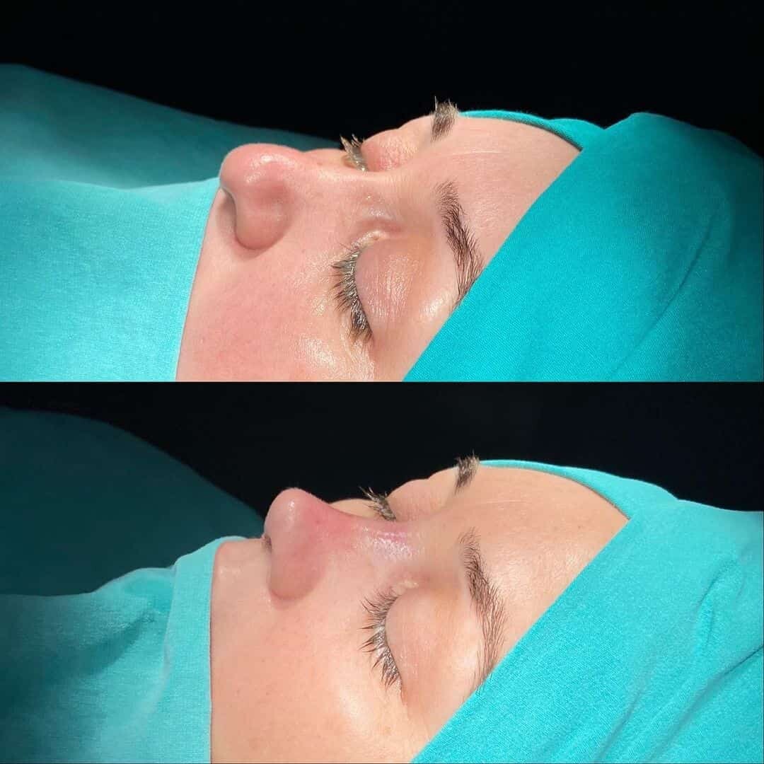 Revision Rhinoplasty 7-3