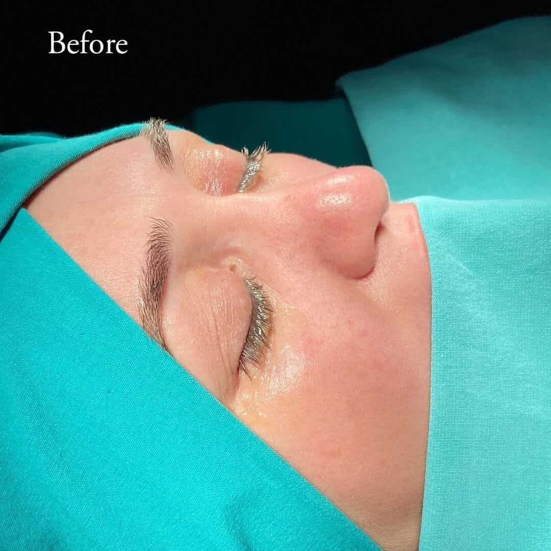 Revision Rhinoplasty 7-4