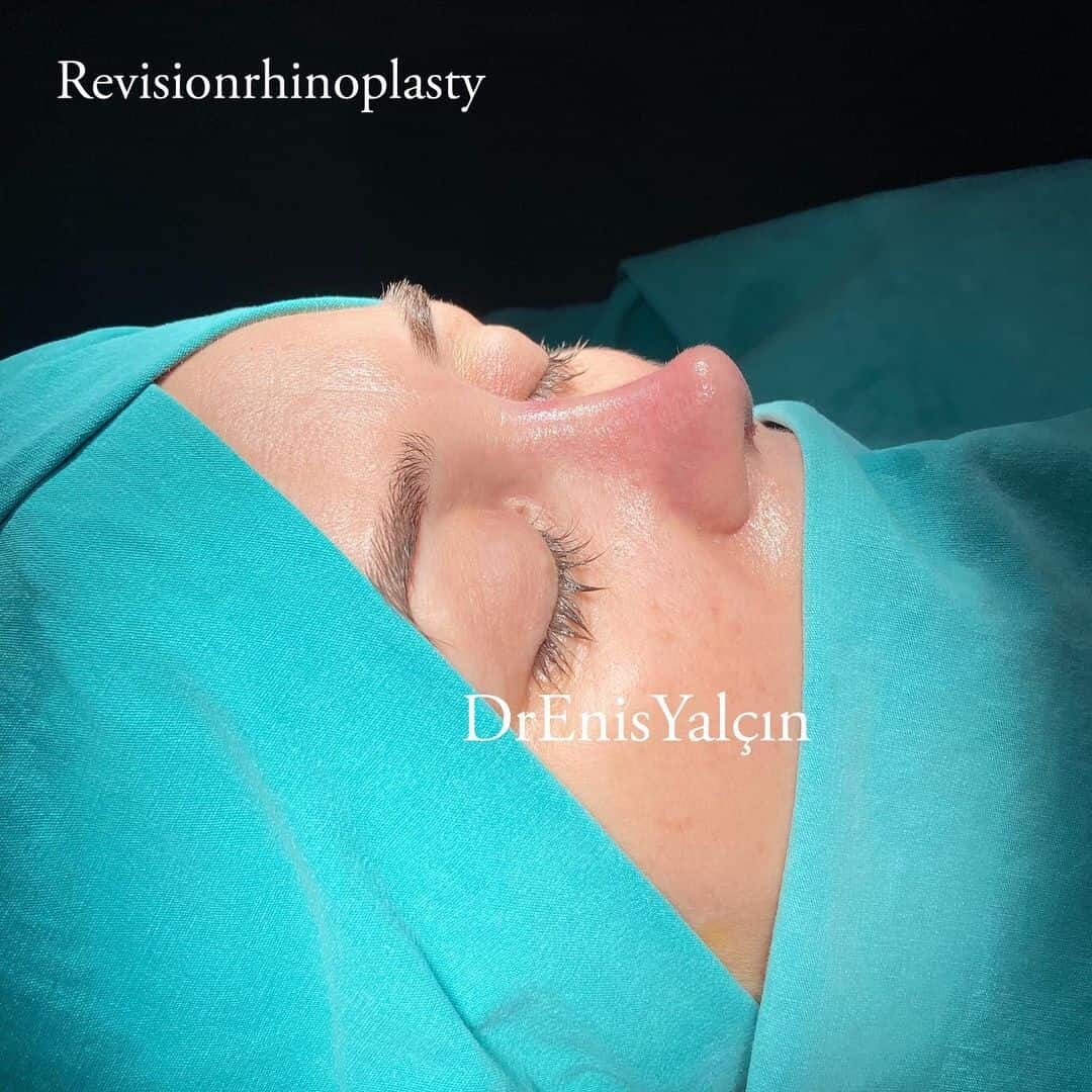 Revision Rhinoplasty 7-5