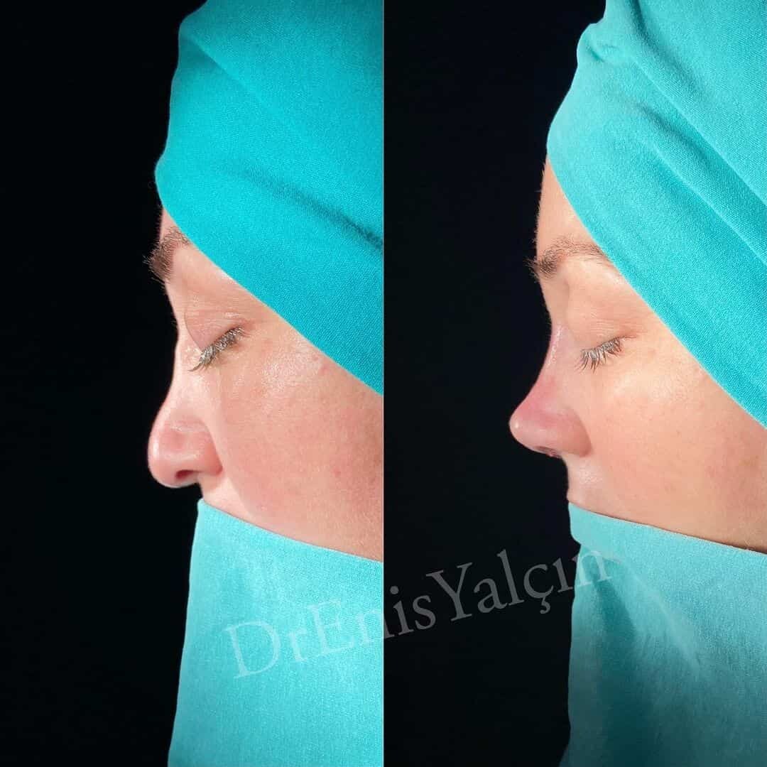 Revision Rhinoplasty 7-6