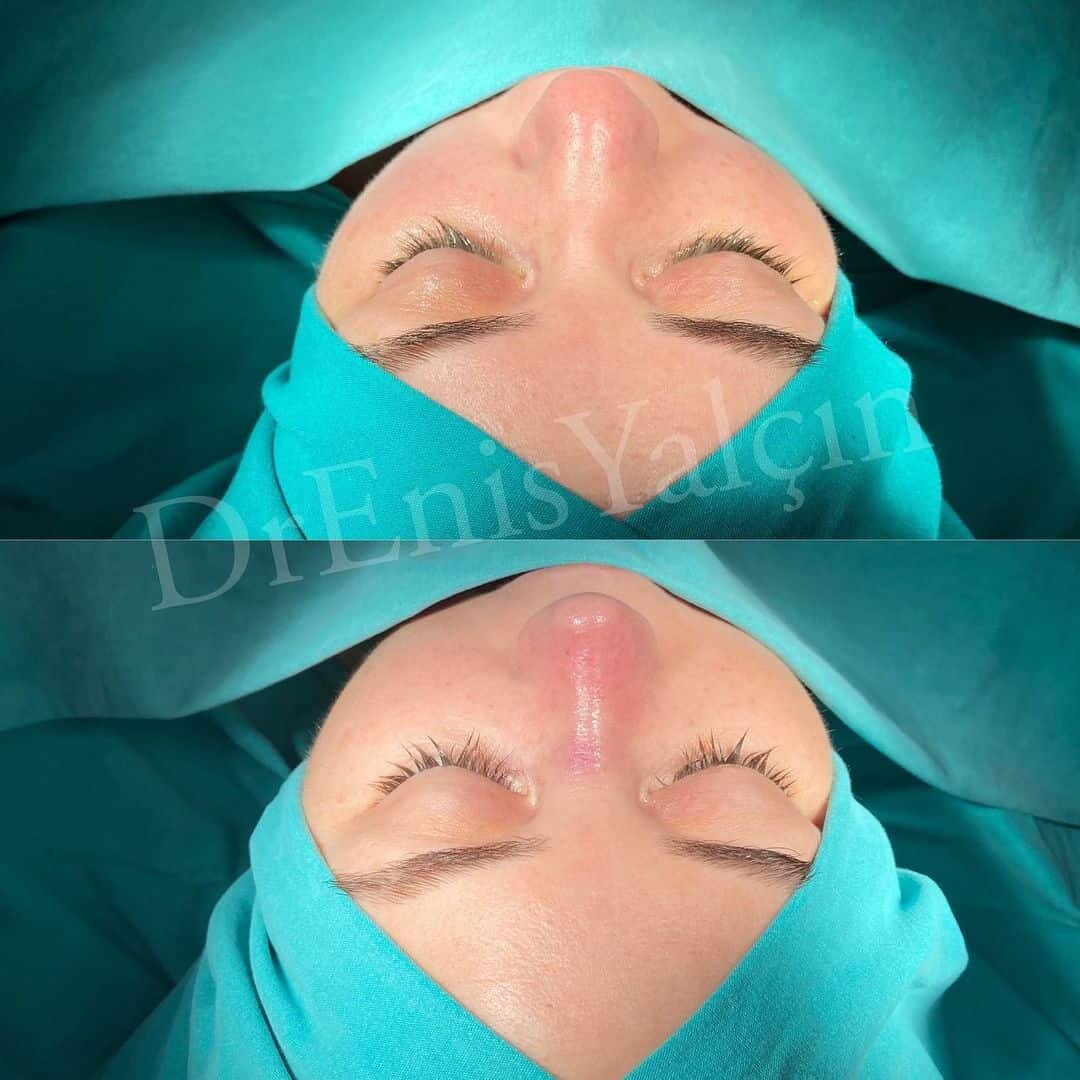 Revision Rhinoplasty 7-7