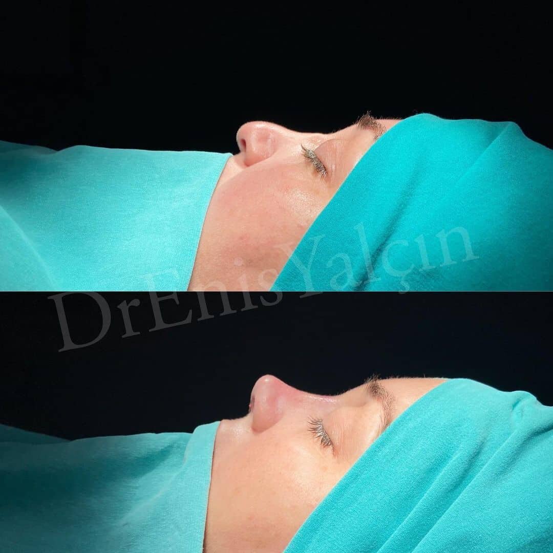 Revision Rhinoplasty 7-8