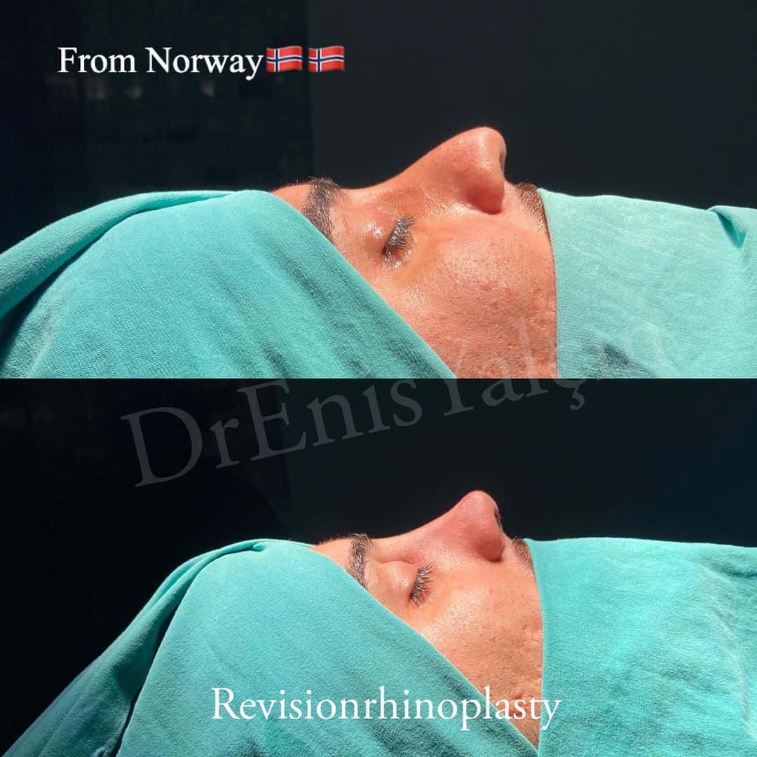 Revision Rhinoplasty 8-1