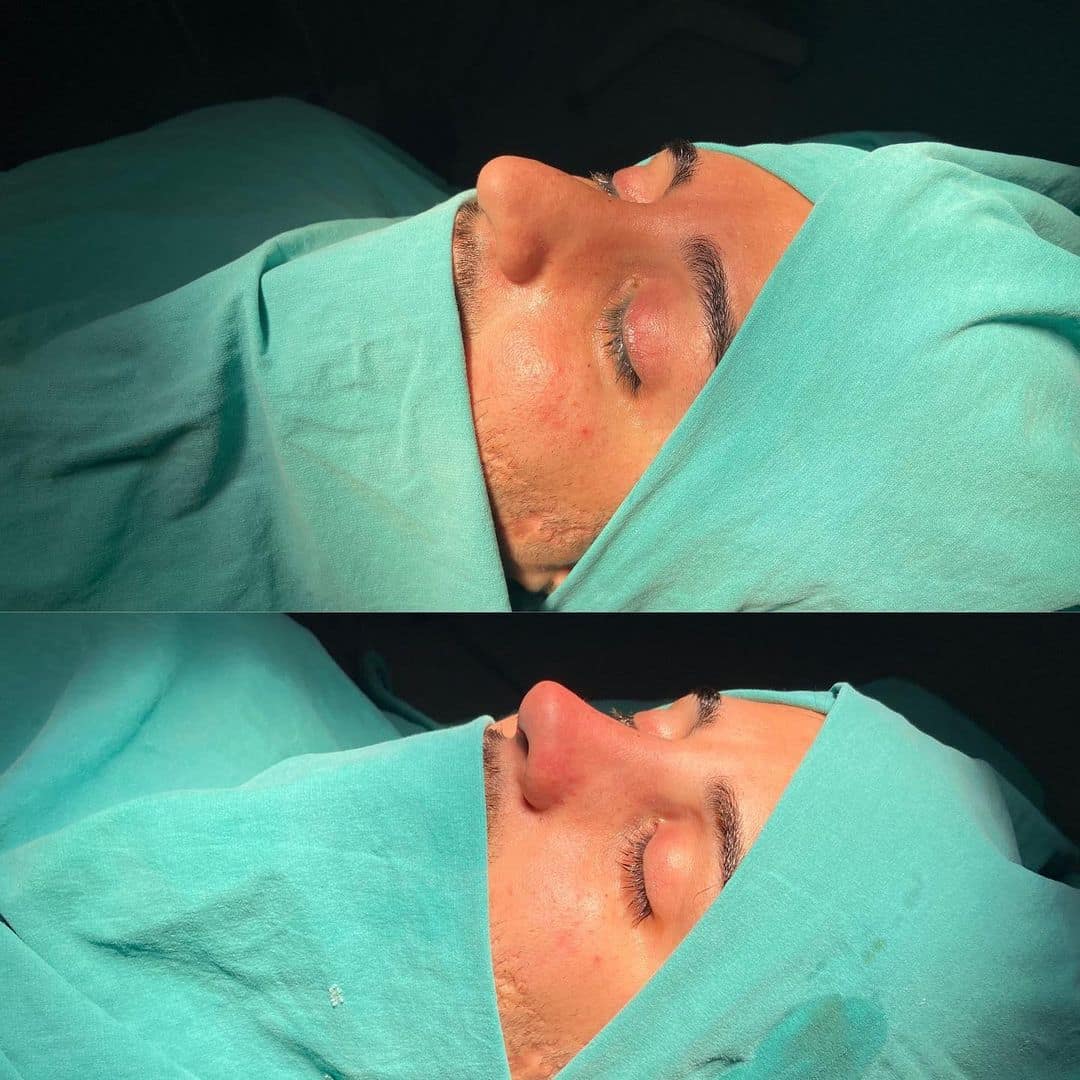 Revision Rhinoplasty 8-2