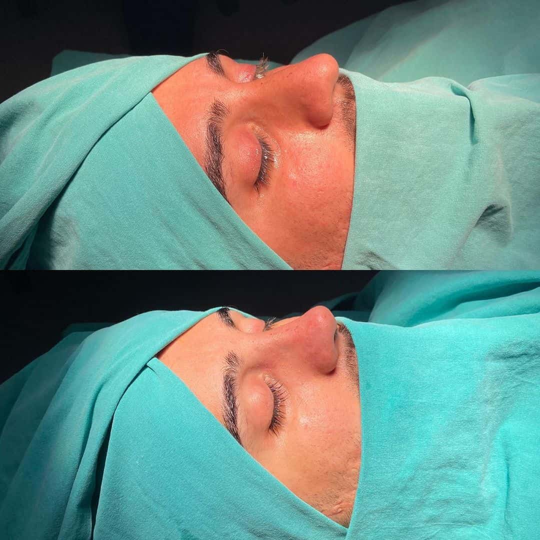 Revision Rhinoplasty 8-3