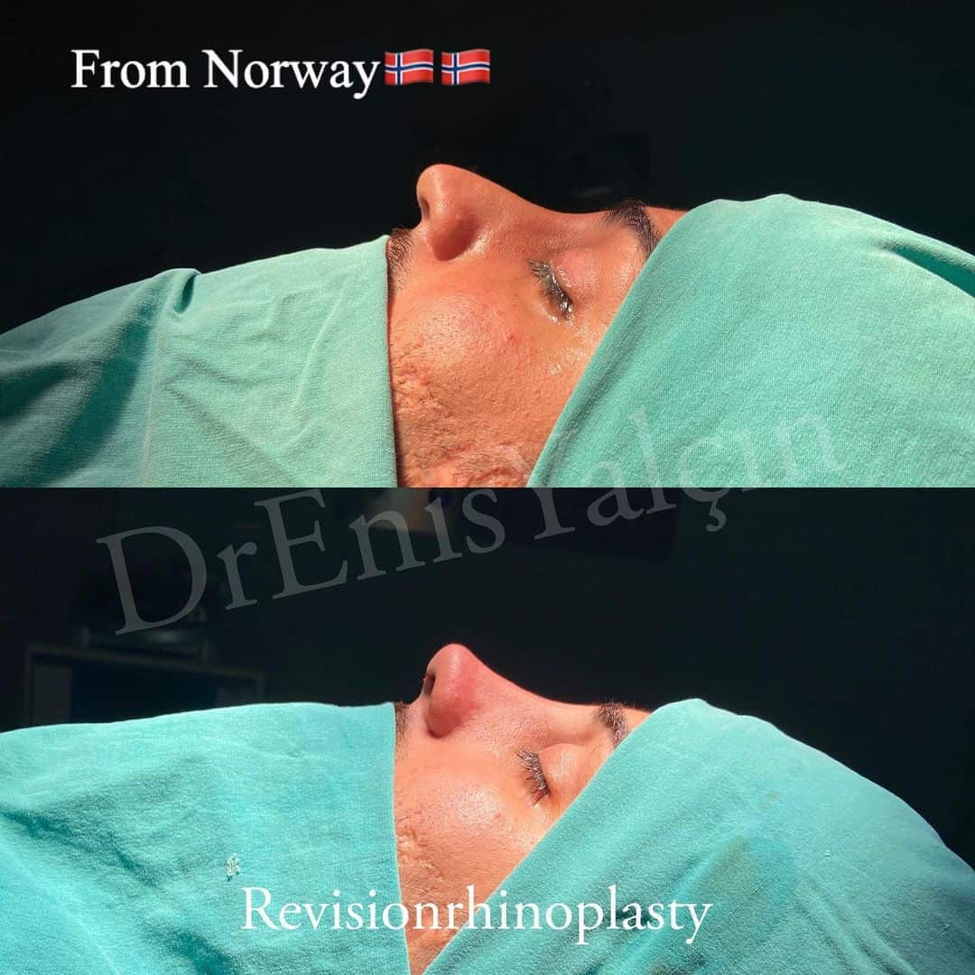 Revision Rhinoplasty 8-4