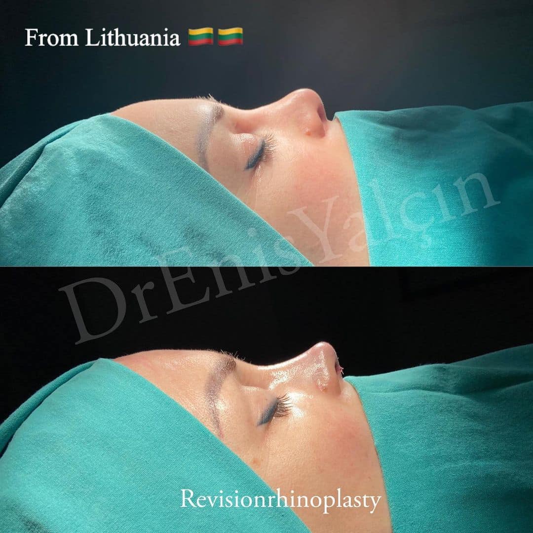 Revision Rhinoplasty 9-1
