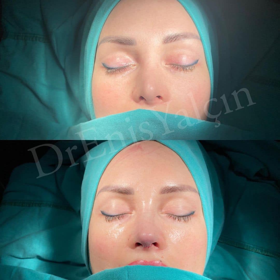 Revision Rhinoplasty 9-2