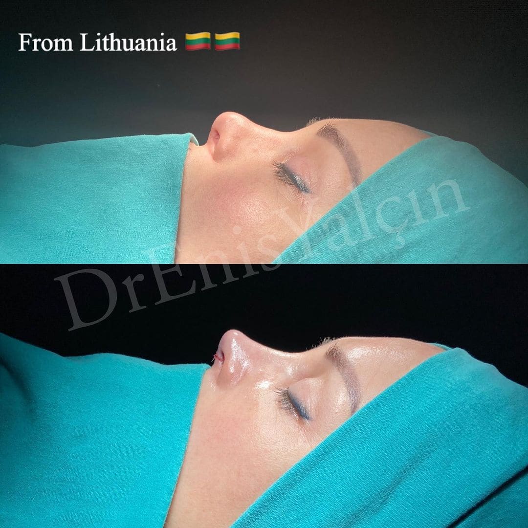 Revision Rhinoplasty 9-3