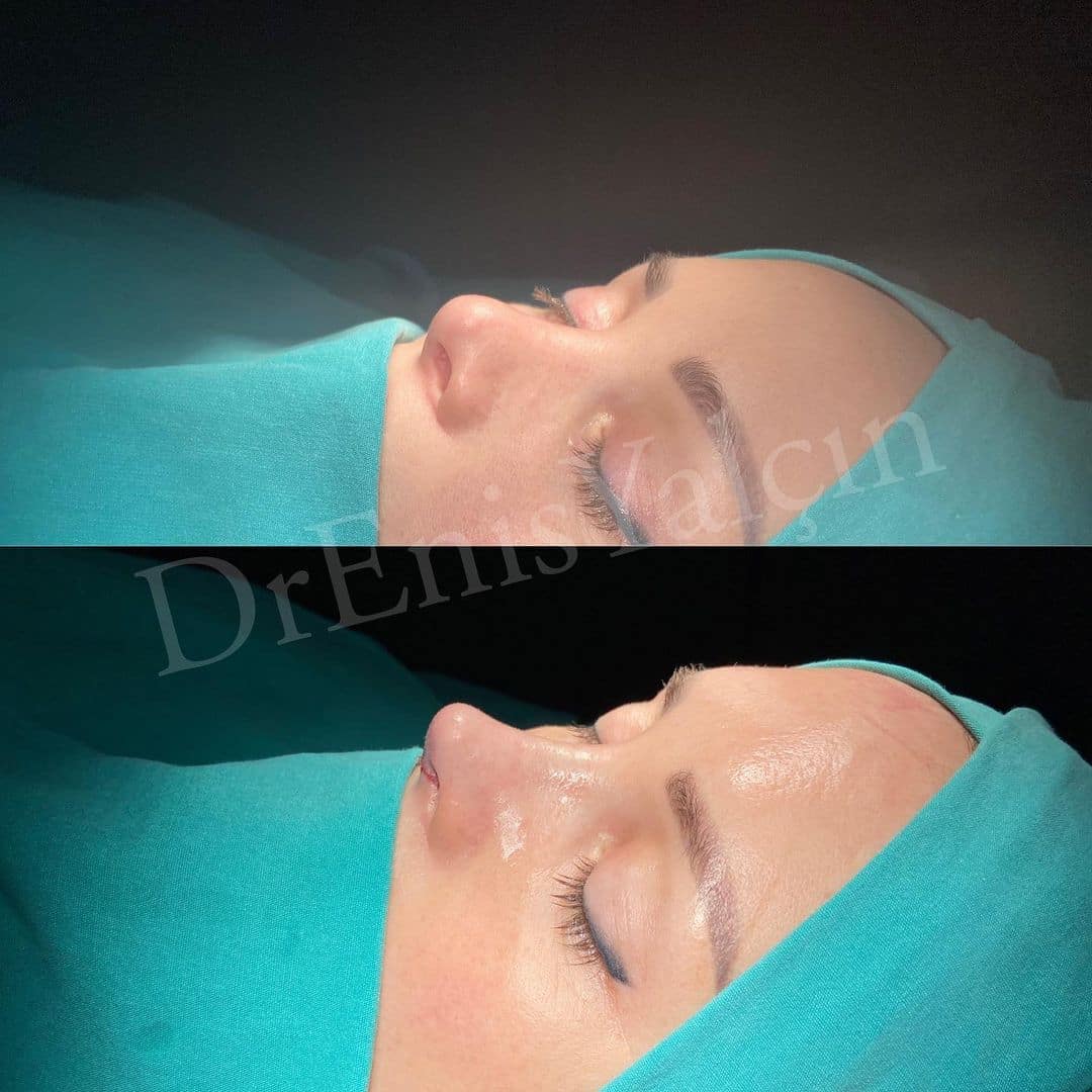 Revision Rhinoplasty 9-4