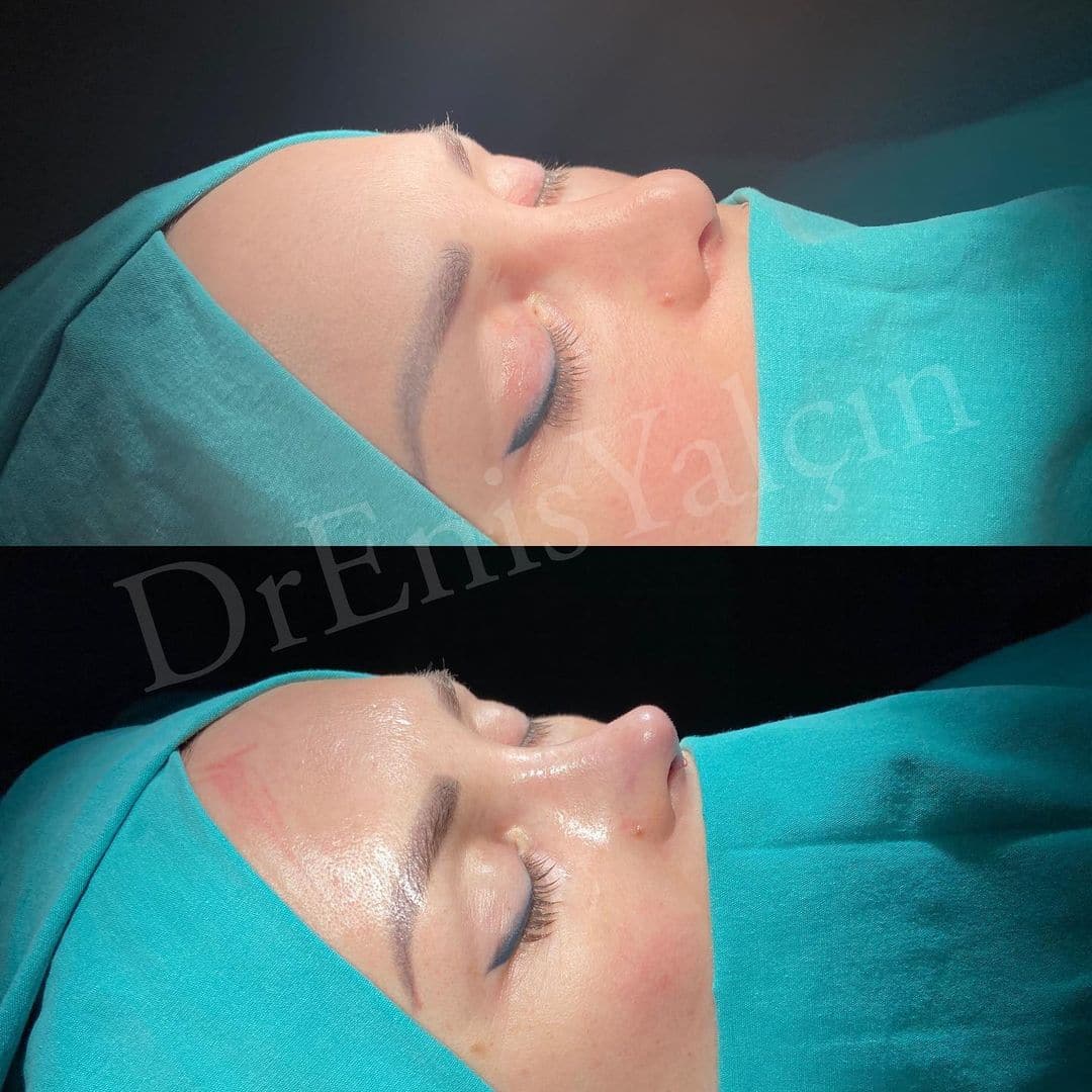 Revision Rhinoplasty 9-5
