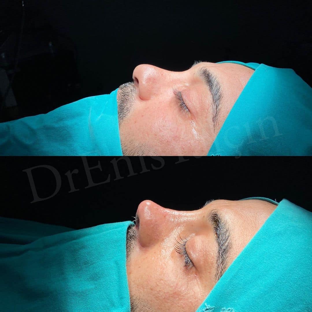 Revision Rhinoplasty 10-1