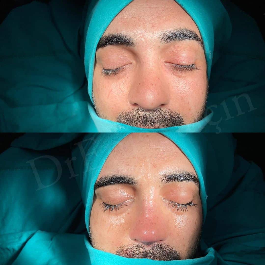Revision Rhinoplasty 10-2