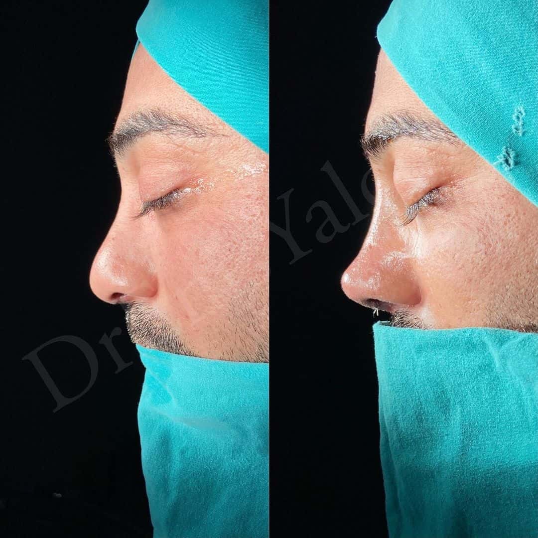 Revision Rhinoplasty 10-3