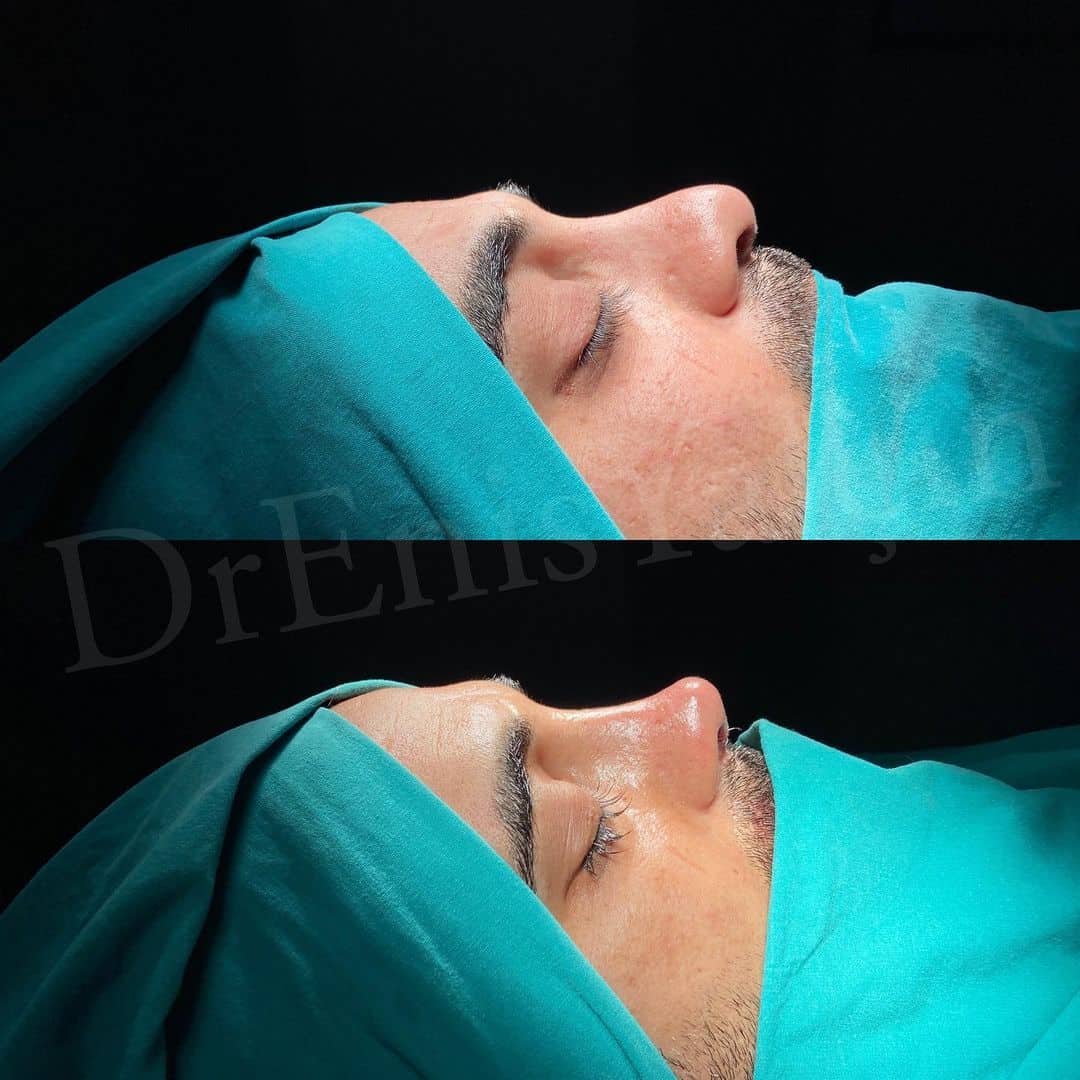 Revision Rhinoplasty 10-4