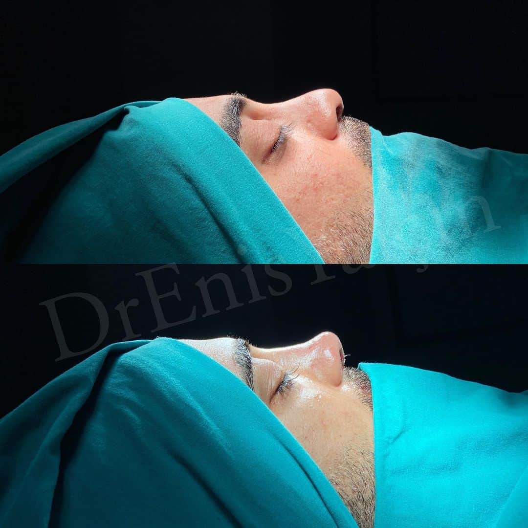 Revision Rhinoplasty 10-5