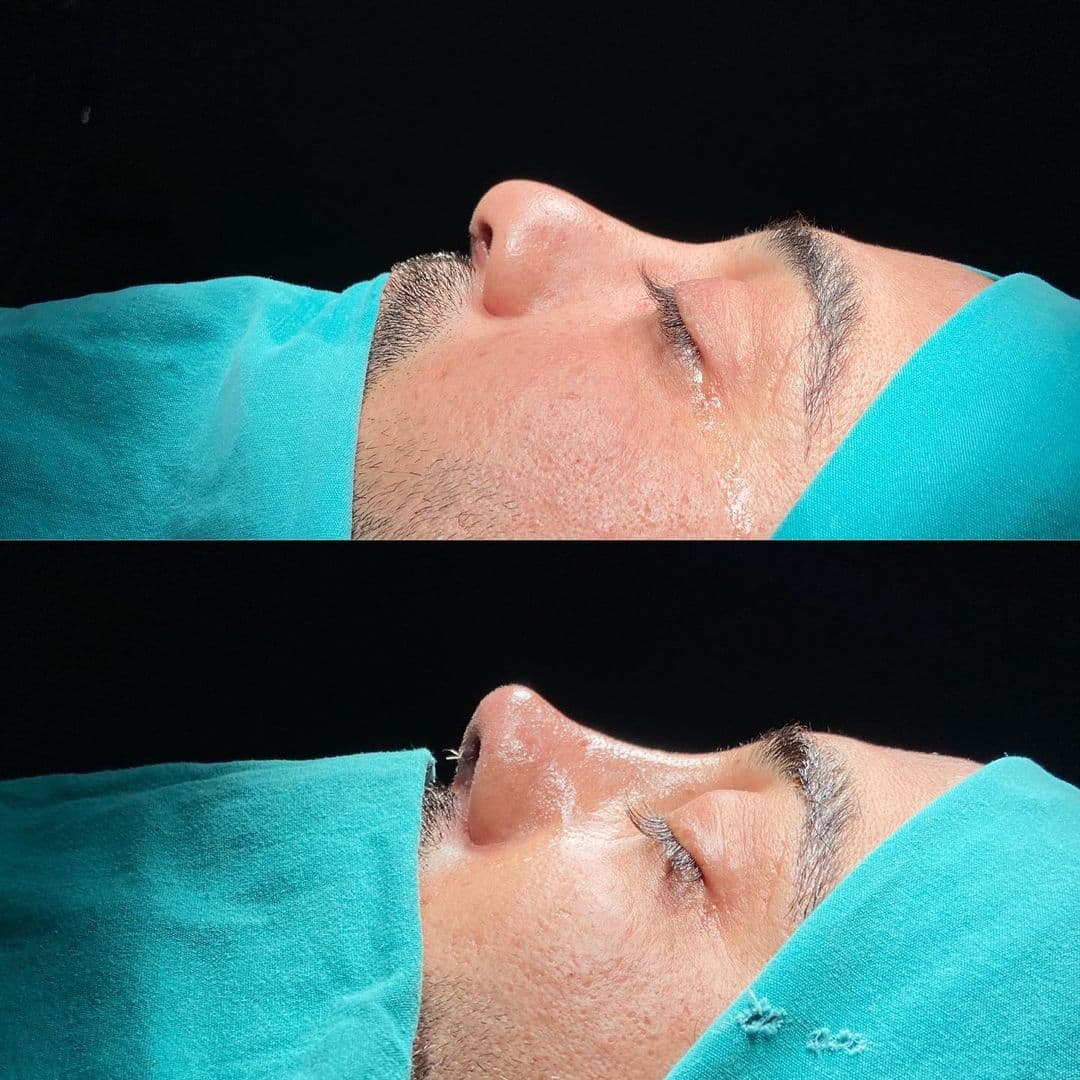 Revision Rhinoplasty 10-6