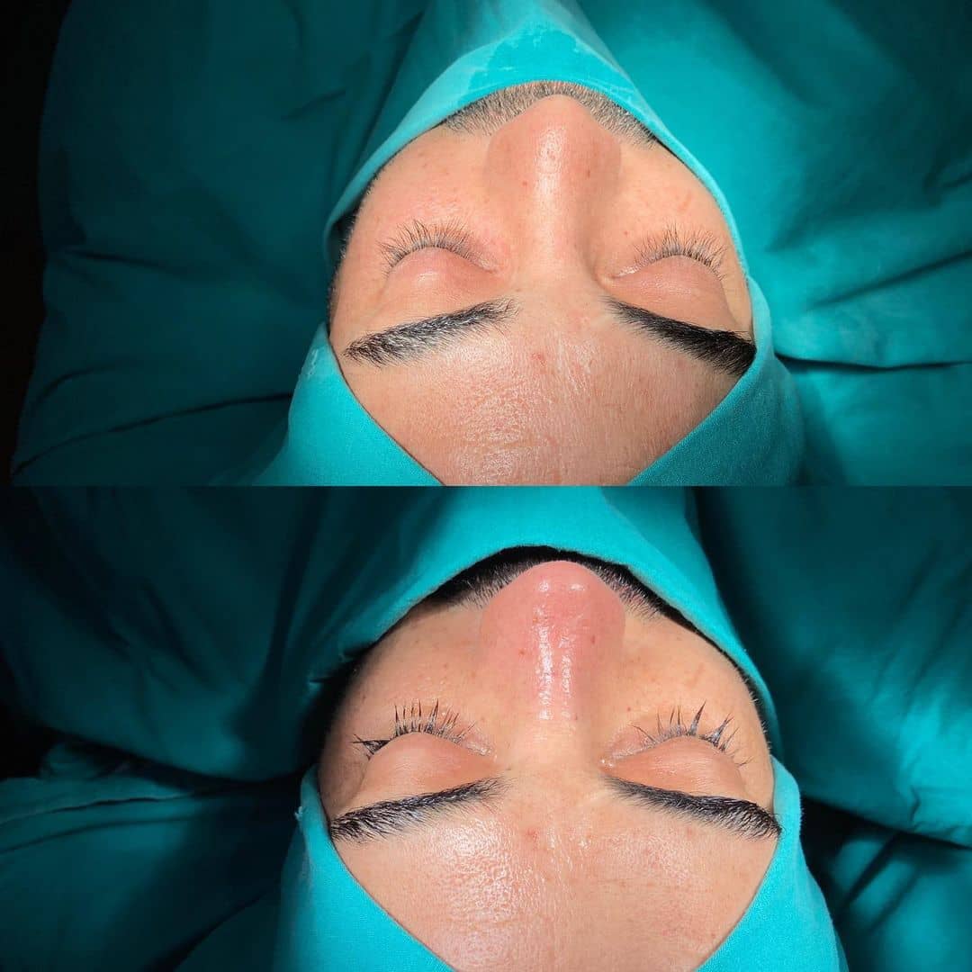 Revision Rhinoplasty 10-7