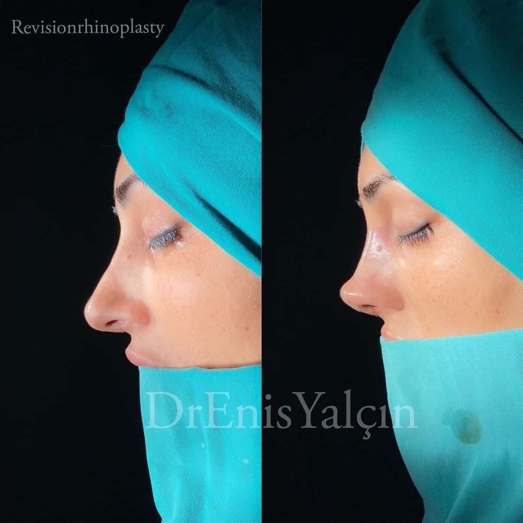 Rhinoplasty before and after result by Op. Dr. Enis Yalçın